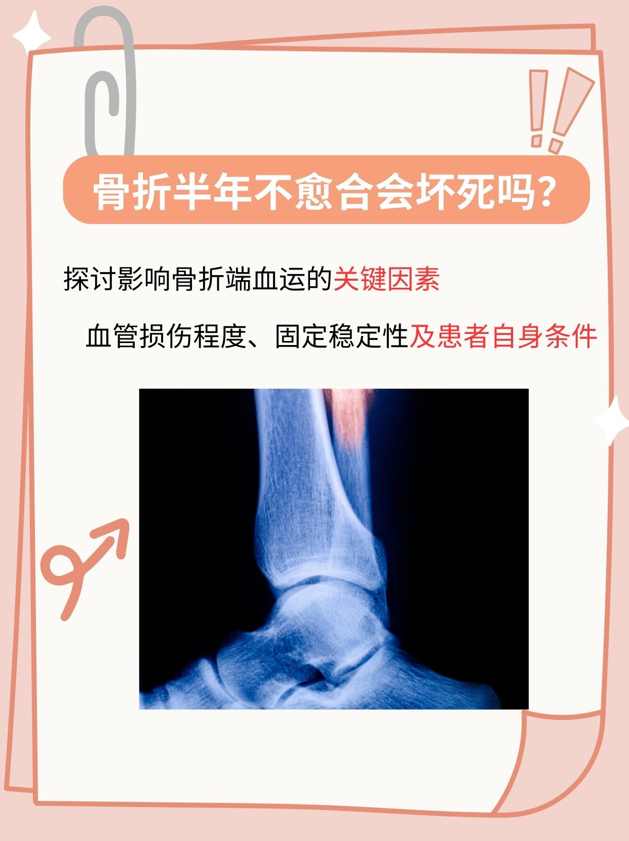 包含穆西亚拉腓骨骨折+韧带受伤预计伤缺4-5个月的词条